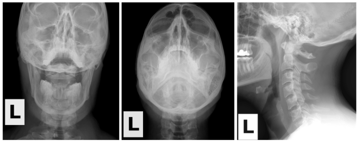 Upper Cervical Views