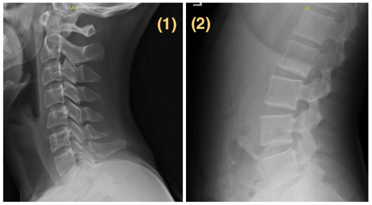 How-Old-is-Your-Spine